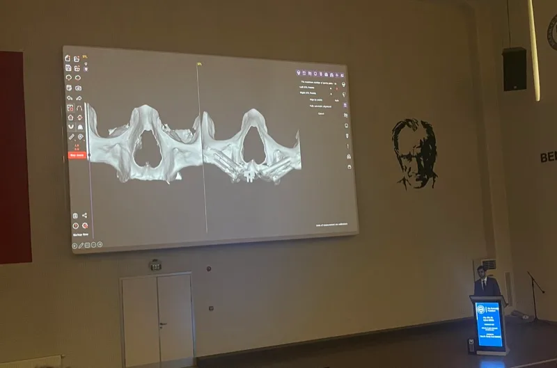 Zygomatic implant digital planning - 3D maxillary model analysis, specialty thesis presentation