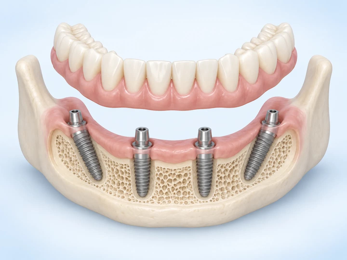 Alt çenede iki ön ve iki açılı arka implant ile bunların üzerinde ayrı gösterilen tam çene sabit protez